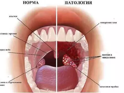 Хронический тонзиллит