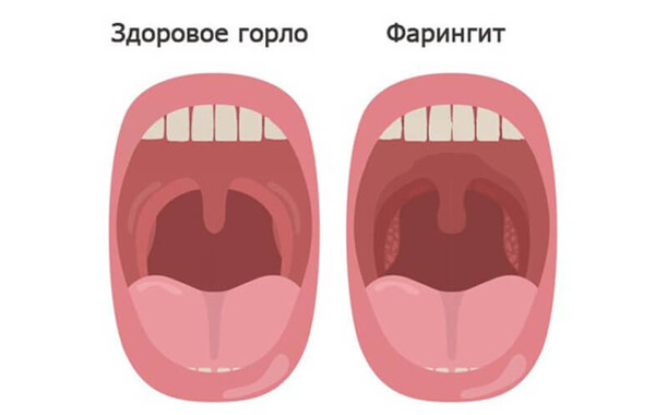 Фарингит
