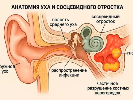 Мастоидит