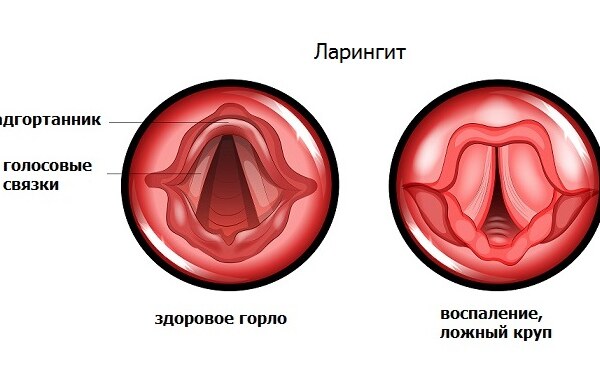 Ларингит
