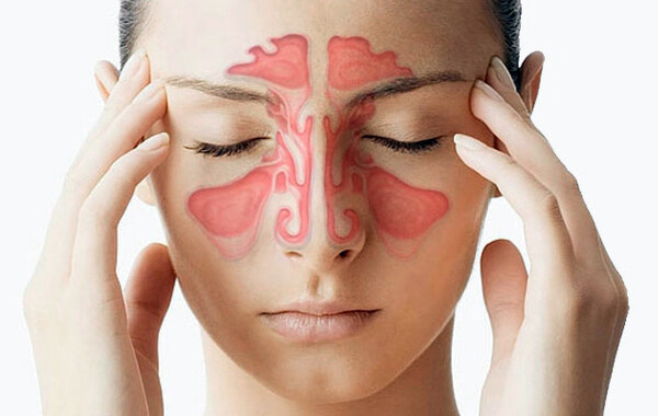 Синусит