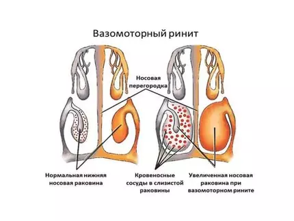 Вазомоторный ринит