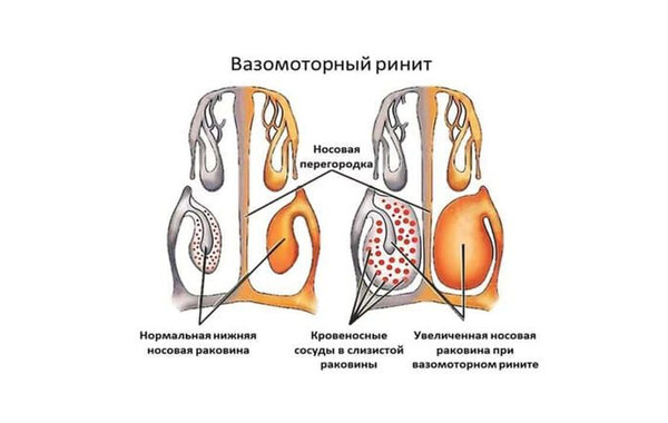 Вазомоторный ринит